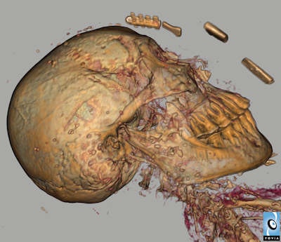 The mummy has a full set of teeth that are generally in good condition. Among other amulets on the head, there are two winged scarab amulets, one on the outer wrappings and one close against the skull beneath the wrappings that is not visible externally. Image generated from Fovia software. Image courtesy of and copyright of the National Museum of Scotland.