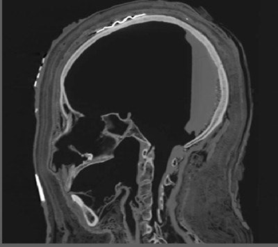 Sagittal reconstruction of the skull with amulets and mummification damage to the ethmoid sinus. Image courtesy of and copyright of the National Museum of Scotland.