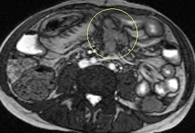 Axial true fast imaging with steady-state precession (FISP) image shows complications of penetrating Crohn's disease. There are multiple thickened loops of small bowel anteriorly in the abdomen with prominence of the vascular arcades. One loop in the left side of the abdomen shows local perforation with abscess collection within the mesentery (circle). All images courtesy of Dr. Nyree Griffin.