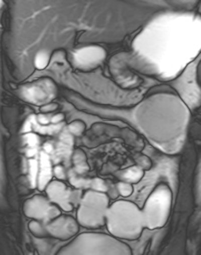 Example Of Predominantly Fibrostenotic Disease