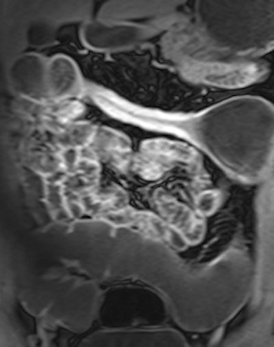 Example of predominantly fibrostenotic disease. Coronal true FISP (Left) and coronal T1 fat-saturated (Right) postcontrast images shows long stricture in the transverse colon with fibrofatty proliferation in the adjacent mesentery. There is dilatation distal to this stricture secondary to a further stricture in the descending colon (not shown).