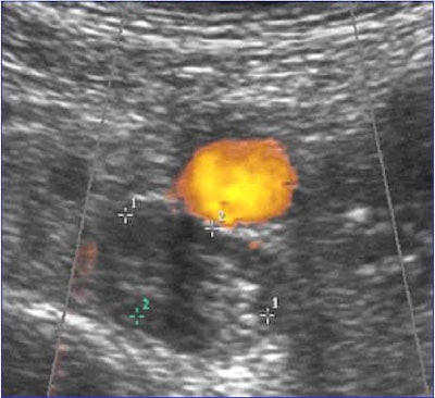 Ultrasound image of deep vein thrombosis. All images courtesy of Dr. Grégoire Le Gal.