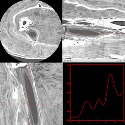 Multiplanar reformats and density spectrum demonstrate papyrus scroll behind right femur and held in mummy's hand. Image courtesy of and copyright of the National Museum of Scotland.