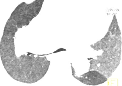 2012 05 01 10 50 56 63 2012 05 01 Pediatric Ct Fig8f