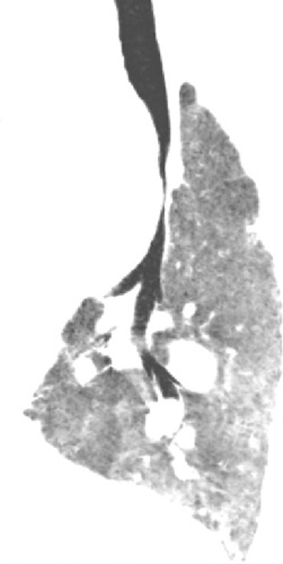 Same 14-year-old patient, there is mark dilatation of the pulmonary tree, causing compression of the trachea at the carina (top) and on the left main bronchus behind the aneurysmal right pulmonary artery (bottom)