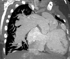 A 14-year-old patient with transposition of greater arteries and gross pulmonary arterial hypertension. CT angiography study shows aneurysmal dilation of the pulmonary arteries (top left, top right), with thrombus in the right middle lobe pulmonary artery (bottom left). There is partial anomalous pulmonary venous return from the right upper lobe to the superior vena cava (arrow, bottom right).