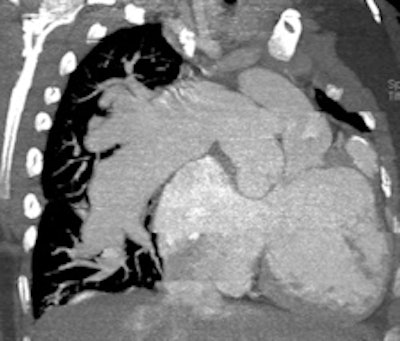 A 14-year-old patient with transposition of greater arteries and gross pulmonary arterial hypertension. CT angiography study shows aneurysmal dilation of the pulmonary arteries (top left, top right), with thrombus in the right middle lobe pulmonary artery (bottom left). There is partial anomalous pulmonary venous return from the right upper lobe to the superior vena cava (arrow, bottom right).