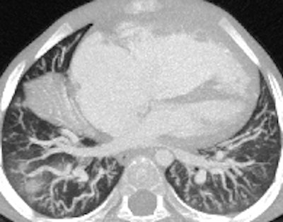 Retrospective ECG-gated study on a 5 year old with severe pulmonary hypertension. The CT images show dilated pulmonary arteries (top left). There is right atrial and ventricular dilatation with hypertrophy and bowing of the interventricular septum into the left ventricle (arrow, top right). There is abnormal arborization and angulation of the peripheral pulmonary arteries (top right, bottom), with multiple peripheral centrilobular nodules with perilesional ground-glass attenuation. Features are in keeping with pulmonary capillary hemangiomatosis.