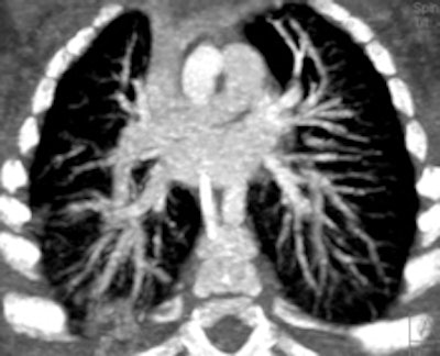 Retrospective ECG-gated study on an 8 month old with pulmonary hypertension shows narrowing of the inferior left pulmonary vein (arrow, left). The peripheral venous vessels (right) are also ecstatic, reflecting a more widespread pulmonary venous abnormality.