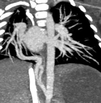 Maximum intensity projection image
