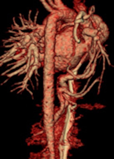 Prospective ECG-gated study on an unsedated free-breathing 2-month-old girl with an average heart rate of 122 beats per minute (bpm). The right pulmonary artery is hypoplastic (top left). An aortopulmonary collateral arising from the celiac axis supplies the right lung, as shown in the volume-rendered image (top right) and the maximum intensity projection image (bottom). All figures courtesy of Carolyn Young.