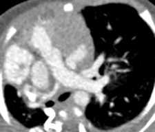 Right pulmonary artery is hypoplastic