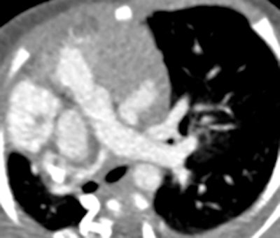 Right pulmonary artery is hypoplastic
