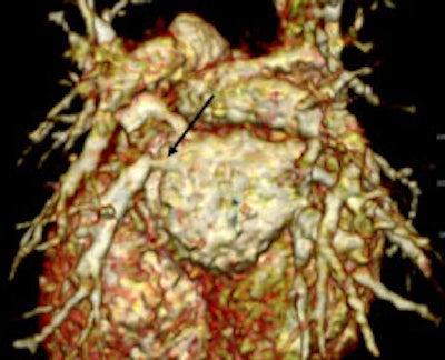 Retrospective ECG-gated study on an 8 month old with pulmonary hypertension shows narrowing of the inferior left pulmonary vein