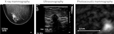 Mixed infiltrating lobular and ductal carcinoma in right breast of 57-year-old patient. The craniocaudal x-ray mammogram (left) shows an architectural distortion of about 22 mm in the lateral part of the right breast. Ultrasound (middle) shows the presence of an smooth-edged hypoechoic lesion with a hyperechoic border at the expected location. Photoacoustic mammography (right) shows a confined high-contrast abnormality with a contrast in excess of 5 mm and a maximum diameter of 14 mm at the expected lesion depth. Here, a transversal cross-section through this abnormality is visualized. All images courtesy of Michelle Heijblom, University of Twente.