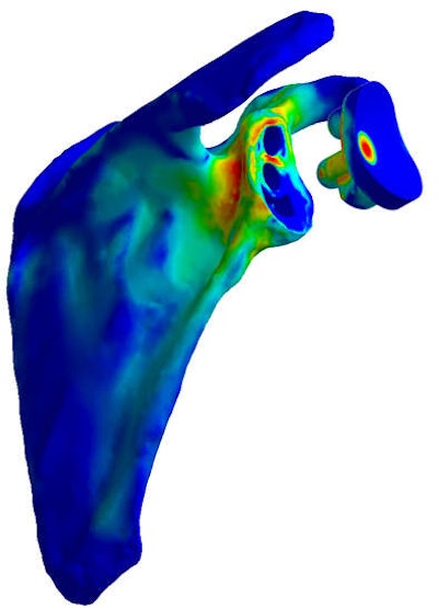 Fit by numbers -- 3D models allow for individually optimized implants. Image courtesy of Dr. Karl Entacher.