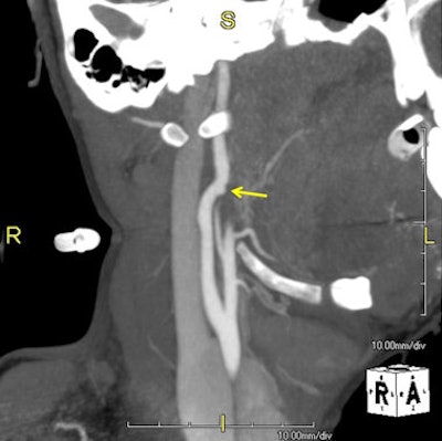 Sagittal oblique maximum intensity projection