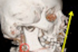 2012 05 17 08 54 15 647 2012 05 17 Gunshot Thumb