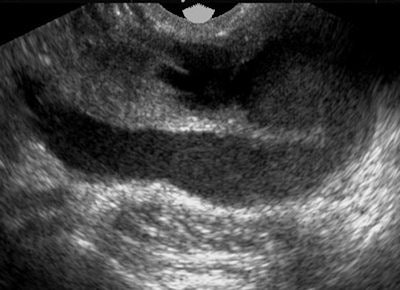 Pyosalpinx on ultrasound