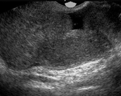 Pyosalpinx on ultrasound