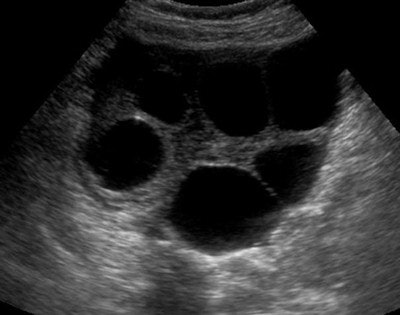 Multiple ovarian cysts on ultrasound