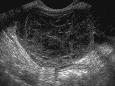 Endometrioma on ultrasound