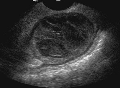 Endometrioma on ultrasound