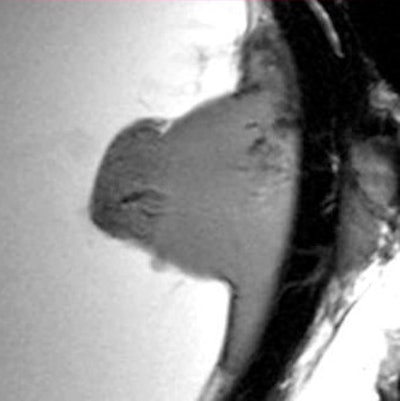 Section enlargement of a T-weighted sagittal image of a malignant uveal melanoma with infiltration of vitreous body, as well as extraocular growth infiltrating the sclera. All images courtesy of the radiology department, University Hospital Greifswald, and pathology department, University Hospital Rostock.