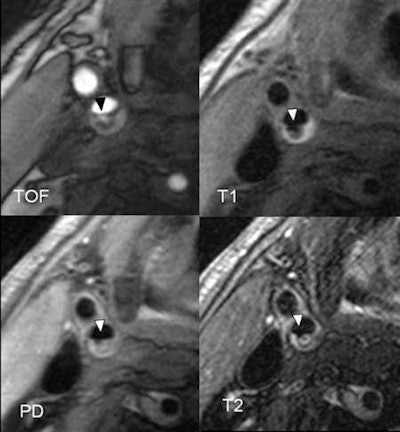 Follow-up examination after 12 months shows a recent ulceration (point of arrow). The patient had a scotoma caused by a smaller thrombus. The most likely cause of this is plaque material that had broken off and led to the ulceration.