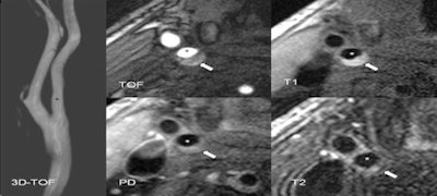 Images of a patient aged 66, enrolled in the CAPIAS study in spring 2011 due to a right-hand infarction of the middle cerebral artery. The initial MRI showed a large and complex plaque with recent hemorrhage and lipid tissue (arrow), identified as complex type VI plaque based on categories of the American Heart Association. These plaques are considered particularly vulnerable, involving a high risk of cerebrovascular events. No stenosis is present. The lumen of the ICA is marked by the asterisk (*). All images courtesy of department of radiology, Ludwig Maximilian University Munich.