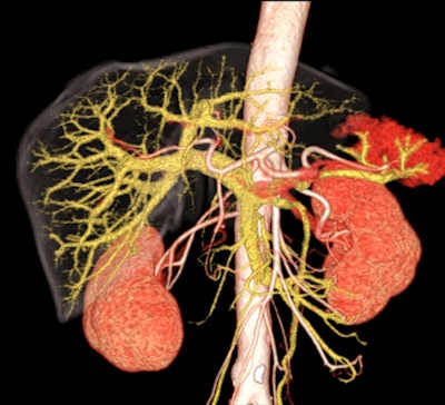 3D CT scans supply incredibly detailed information about the abdomen, but are such investigations always clinically valuable? Image courtesy of Hitachi.