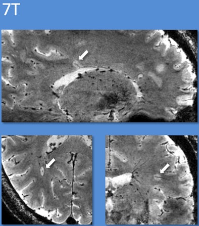 7-tesla MRI for multiple sclerosis