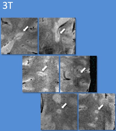 3-tesla MRI for multiple sclerosis