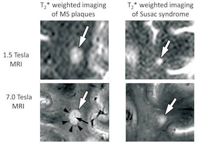 Examples of T2*-weighted imaging of multiple sclerosis (MS) (left) versus Susac syndrome (right) white-matter lesions at 1.5 tesla (top) and 7 tesla (bottom). At 1.5 tesla, both MS and Susac syndrome white-matter lesions (white arrow) appear similar as hyperintense lesions.3 Due to the enhanced signal-to-noise ratio, contrast-to-noise ratio, and improved spatial resolution at 7 tesla, ultrahigh-field MRI reveals distinctive lesion morphology: MS lesions are characterized by a central vein (black arrow) and in particular a hypointense rim (arrow head). In comparison, white-matter lesions in Susac syndrome do not show a hypointense rim, and therefore appear blurry. Perivenous arrangement is not a typical feature of Susac syndrome lesions but can coincidentally occur with veins being most likely located peripherally.3