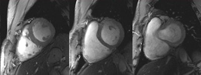 Set of six (top and bottom) 2D CINE FLASH images of the beating human heart derived at systole from a series of 12 short-axis views ranging from the apex to the base of the heart (in-plane resolution [1 x 1] mm2, slice thickness of 4 mm, acceleration factor = 2, GRAPPA). A 2D 16-channel transmit/receive radiofrequency coil array was used for signal transmission and reception.6 The images illustrate that a rather uniform intensity distribution was obtained across the entire heart.6