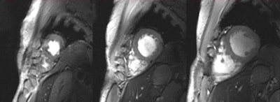 2D CINE FLASH images of the beating human heart