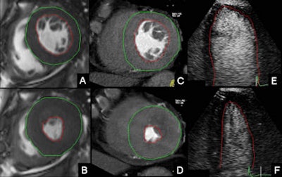 Left ventricular (LV) manual contour tracing for the assessment of LV parameters in cardiac MRI (CMR), cardiac dual-source CT (DSCT) and 2D contrast-enhanced echocardiography (CE echo). A, B: CMR short-axis views. C, D: Cardiac DSCT short-axis views. E, F: Two-dimensional CE echo apical four-chamber views. A, C, E: End diastole. B, D, F: End systole. Images courtesy of Dr. Maria Arraiza.