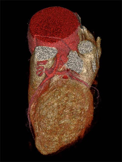 Images of the whole aorta were acquired using a wide-volume protocol; each volume was scanned in a single heartbeat with 16-cm anatomic coverage. The second volume was positioned to cover the whole heart to ensure that all the segments of coronary arteries were in the same dataset. The table is stationary during each acquisition, and then moves to the next location for the next CT data acquisition. Patient is a 23-year-old woman with Marfan syndrome combined with coronary-pulmonary fistula, and a Stanford type A aortic dissection. All images courtesy of Dr. Yu Li.