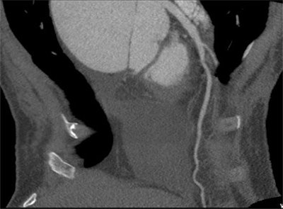 2012 06 12 11 17 06 124 2012 06 12 Cardiac Li image 2nd