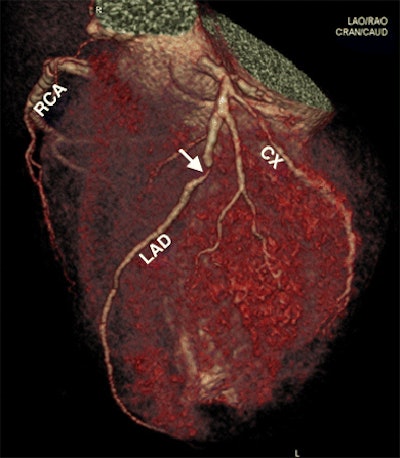 3D volume rendering of heart