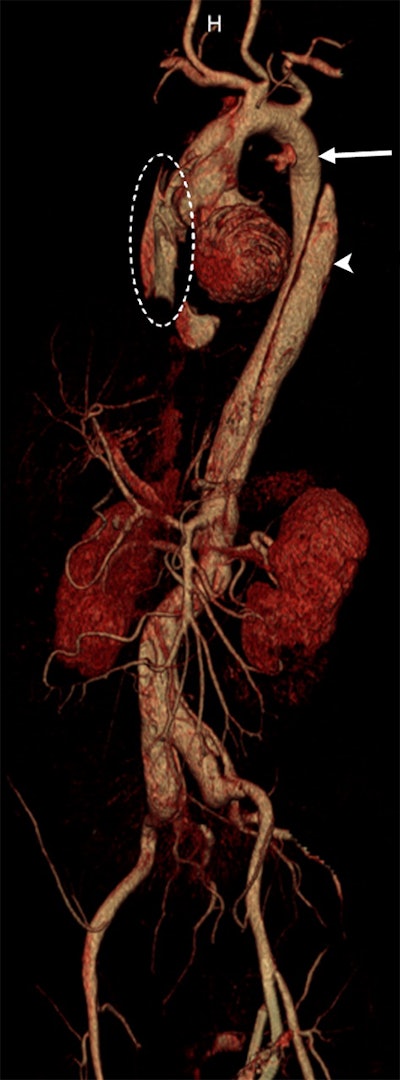 3D volume rendering of thoracoabdominal aorta shows Stanford type A aortic dissection with a small cleft of the adventitia and a 7-mm tear in the intima directly arising from the aortic root and extending into the ostium of the left coronary artery, resulting in hematopericardium. The extravasation (dotted circles) indicates a hemorrhage into the pericardium that led to a fatal tamponade of approximately 750 mL. Note the good delineation of the false (arrowhead) and true (arrow) lumens.