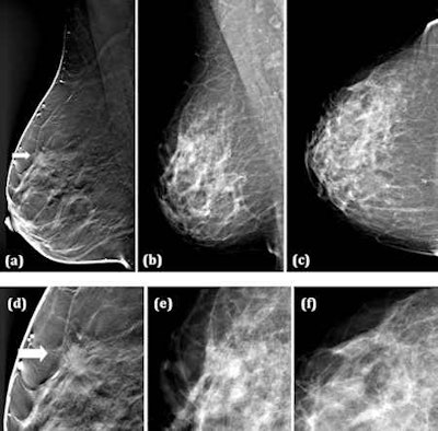 (a) Breast tomosynthesis (BT) mediolateral oblique view (one-view BT), (b) Digital mammography (DM) mediolateral oblique, and (c) DM craniocaudal view (two-view DM), (d-f) close-ups of (a-c). A 49-year-old woman with a 10-mm spiculated invasive tubular carcinoma grade 1. The tumor was detected by 5/5 readers on one-view BT, while on two-view DM (b, c) the tumor was undetected by all the readers. All images courtesy of Tony Svahn, PhD.