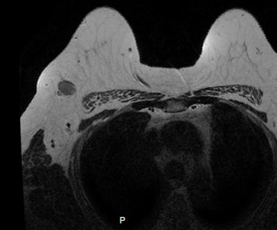 Diffusion-weighted imaging