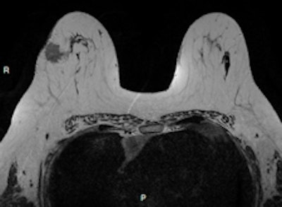 Invasive ductal carcinoma with positive axillary lymphadenopathy. The detection of malignant masses is relatively easy using DWI for both index tumor and axillary positive lymph node. ADC values of the index tumor and positive homolateral lymph node were less than 0.9. This case illustrates the usefulness of DWI to detect both index tumor and positive lymphadenopathy. Images courtesy of Dr. Isabelle Thomassin-Naggara.