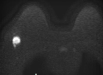 Invasive ductal carcinoma with positive axillary lymphadenopathy