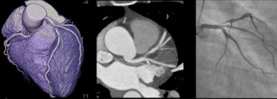 48-year-old woman with a tight stenosis