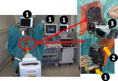 Clinical procedure at Offenbach Clinic, showing the QA-Tools for HDR brachytherapy of prostate cancer. (1) Intraoperative real-time treatment planning system Oncentra Prostate (Nucletron) using 2D and 3D ultrasound imaging. The ultrasound probe remains in place during treatment enabling 2D and 3D verification at any time. (2) Template-Perineum QA tool. (3) Measurement of free length of the needles is utilized for both reconstruction (of needle tip) and quality control for checking needle shifts during treatment. Image courtesy of Dimos Baltas, Klinikum Offenbach.