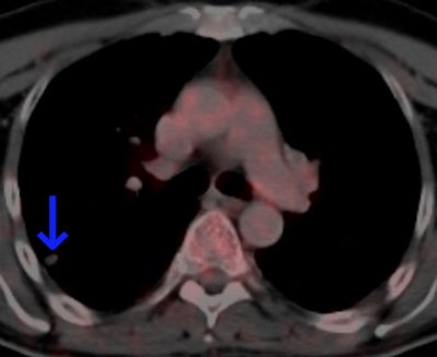 The same patient as seen with the fused color-coded PET/CT image.