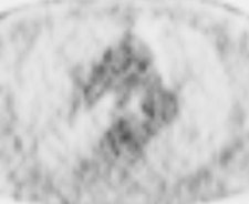 This 62-year-old melanoma patient has a 10-mm metastasis in the right upper lobe. The CT image (left) failed to show increased tracer uptake on the F-18 FDG PET image (right). All images courtesy of Dr. Marius Mayerhoefer.