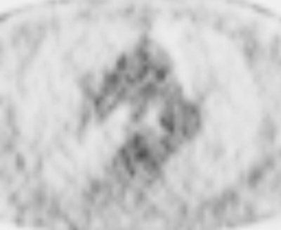 This 62-year-old melanoma patient has a 10-mm metastasis in the right upper lobe. The CT image (left) failed to show increased tracer uptake on the F-18 FDG PET image (right). All images courtesy of Dr. Marius Mayerhoefer.